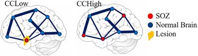 Transfer Function Models for the Localization of Seizure Onset Zone From Cortico-Cortical Evoked Potentials